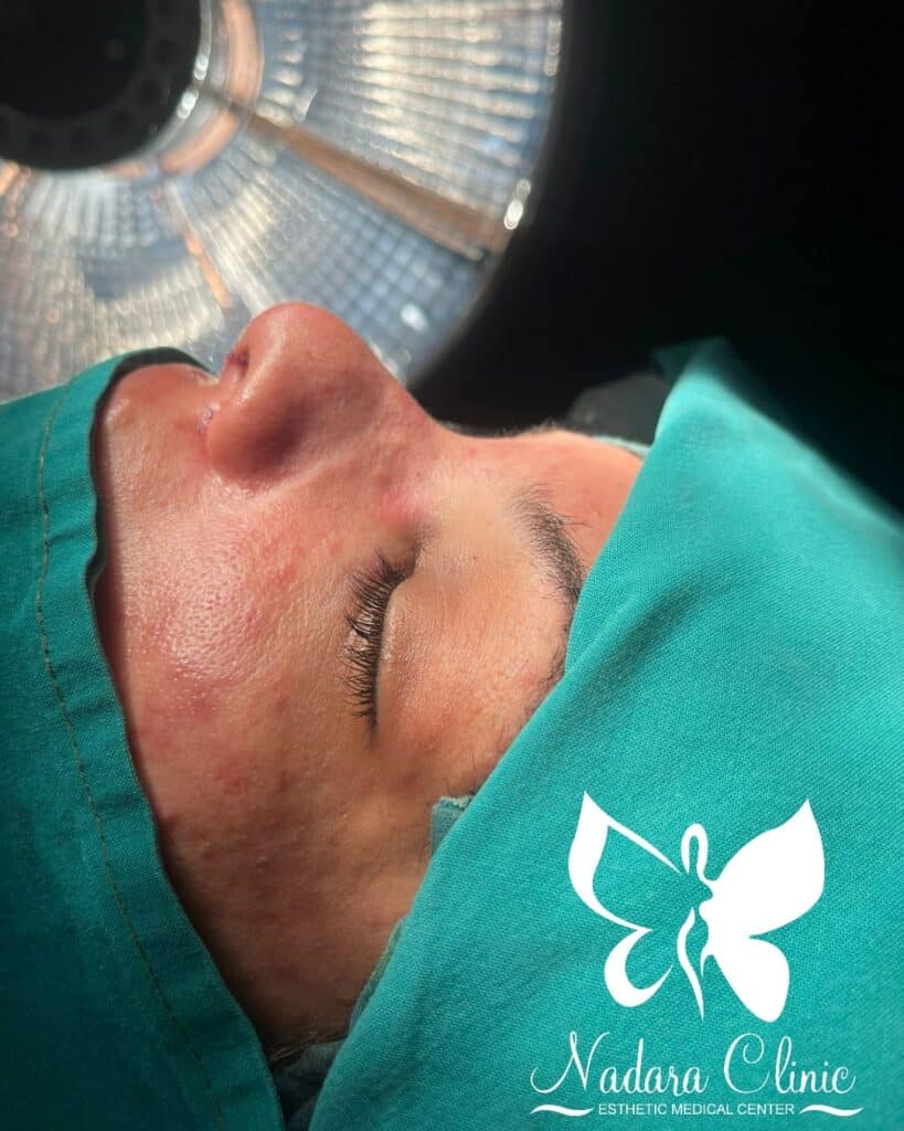 تعديل حجم الانف